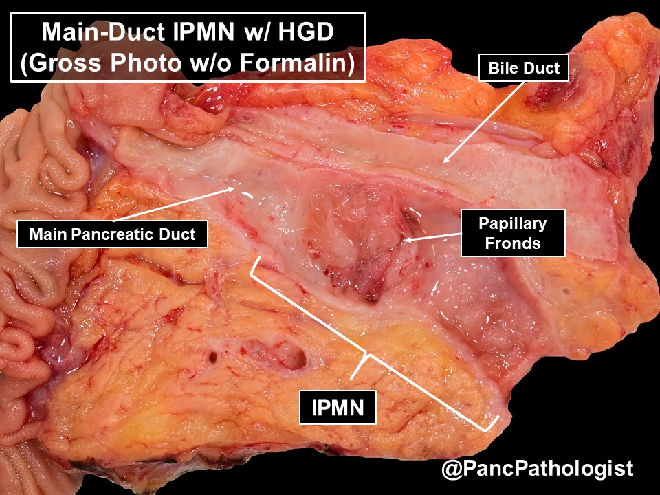 PancPathologist's tweet photo. Main-Duct Intraductal Papillary Mucinous Neoplasm (IPMN) with high-grade dysplasia (HGD). I find it's easier to see when submerged in formalin. Note, the engorged vessels and extension to the resection margin. #PancreaticCancer #PancreaticCyst #GIPath #Pathology #GNAS #TP53 https://t.co/MNnbsTwOXE