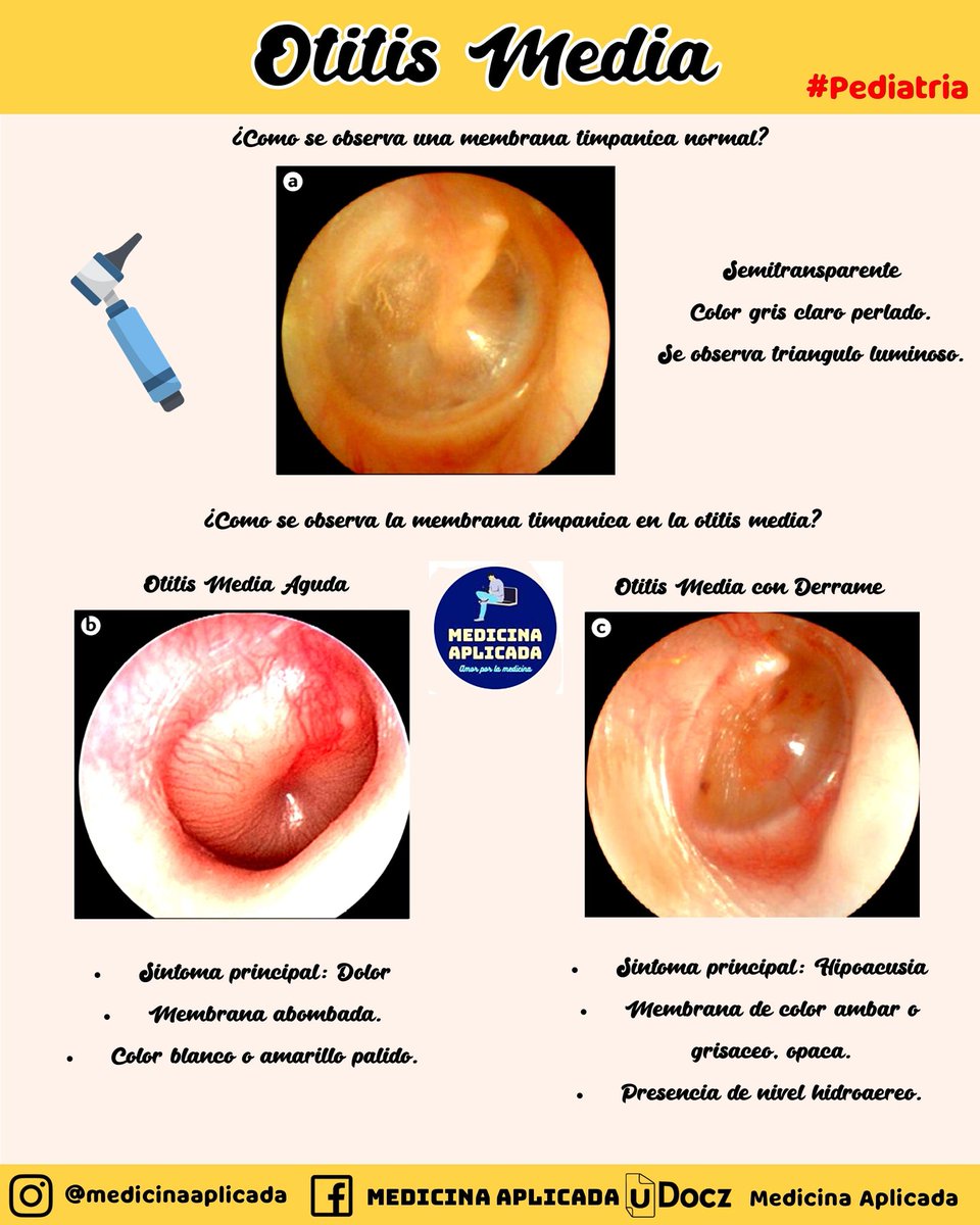 medicinaaplica2's tweet photo. ▶️Buenos dias chic@s! 
🔵Les dejo una resumen de:

⭐ Otitis Media (Diferencial entre Otitis Media Aguda y Otitis Media con Derrame a través de la Otoscopía) 👂
📝 Área de Pediatría

#pediatria #pediatry #otitis #OMA #otitismedia #usmle #step1 #oms #enam #essalud #otoscopia https://t.co/eviiVdSEbM