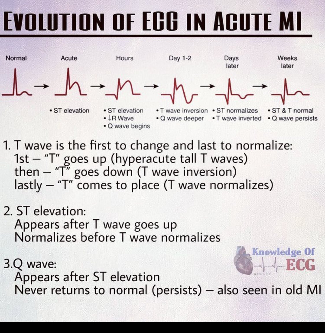 Late night Clinical Pearl for my students: EKG changes in STEMI : @AjeneGeorge <a href="/KNamjouyan/">Kamran Namjouyan</a> <a href="/williamaghaul/">@WilliamAGhaul</a> <a href="/MaddyCunningh14/">Maddy Cunningham</a> @ashley_marmaro <a href="/MelissaRubin17/">Melissa Rubin</a> <a href="/libera_robert/">Robert Libera</a> @JoshLev62127832 @NateMor63724811 @KatieBa93607688