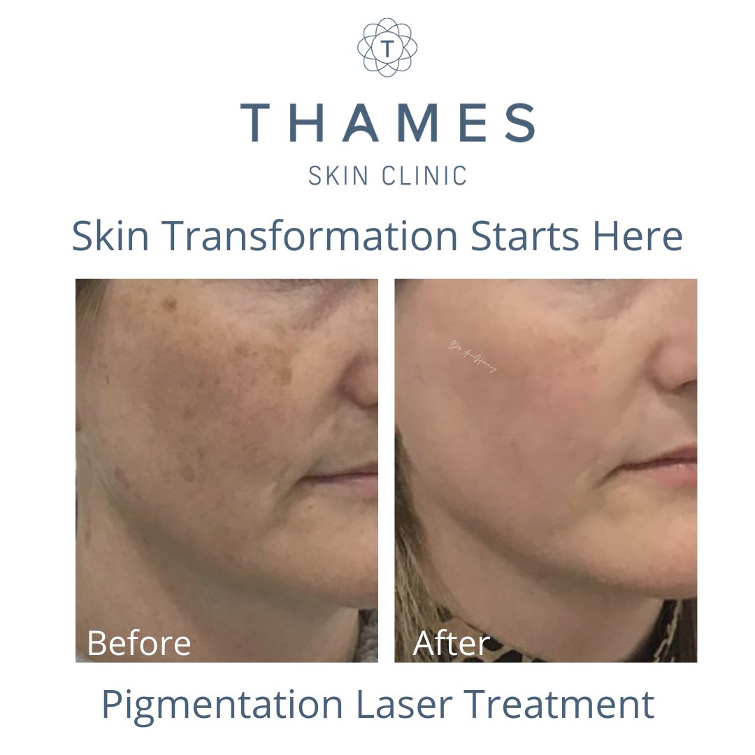 SkinThames's tweet image. Fabulous results from Cutera Excel V+ laser treatment. Taken one month after 1 single session. There is a reason that Cutera Excel V+ Laser treatment is considered to be one of, if not, the best laser treatment in the world. The results speak for themselves. #whycutera #ExcelV