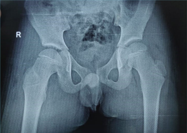 IFClinChem's tweet photo. #eJIFCC case report: pediatric septic arthritis of the hip
Authors: Shireen Prince and Rao Tulasi
https://t.co/5mRErl35KY https://t.co/sjrjfl2mxc