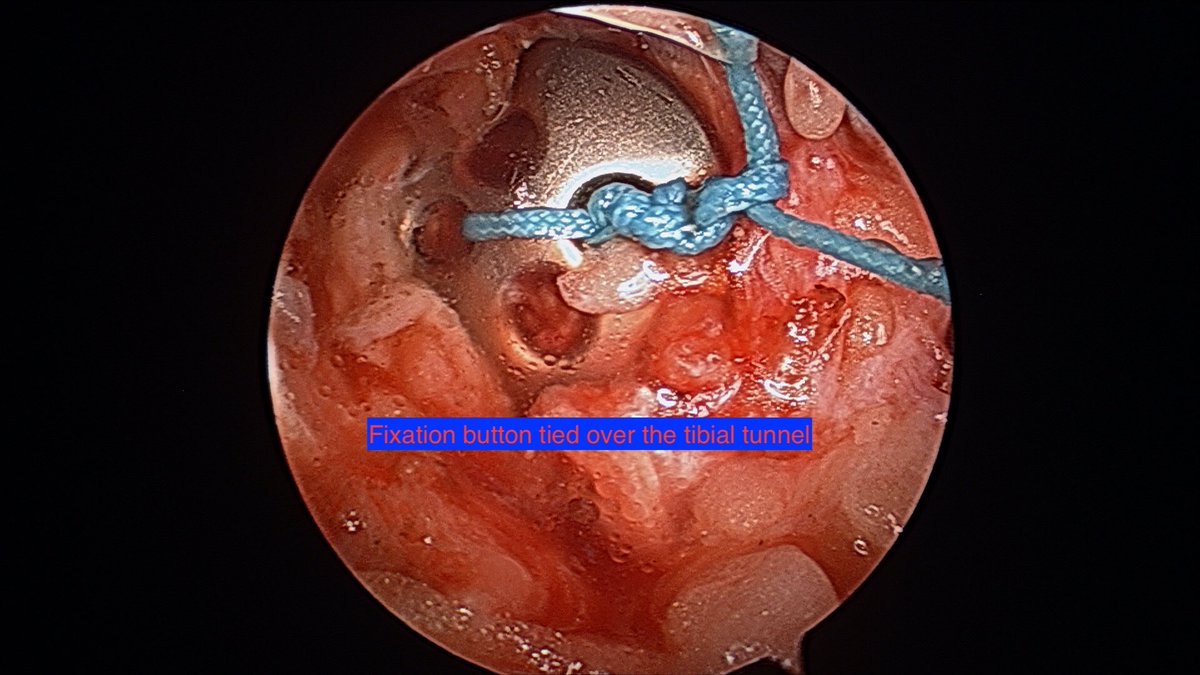 CzarneckiMD's tweet photo. Medial meniscal root repair is critical to protecting a knee joint from degenerating further, as long as there is no major arthritis. It is fragile, requiring prolonged non-weight bearing and limiting knee flexion to 90 degrees for a month #kneearthroscopy #meniscalrootrepair https://t.co/qj251Ws1VG