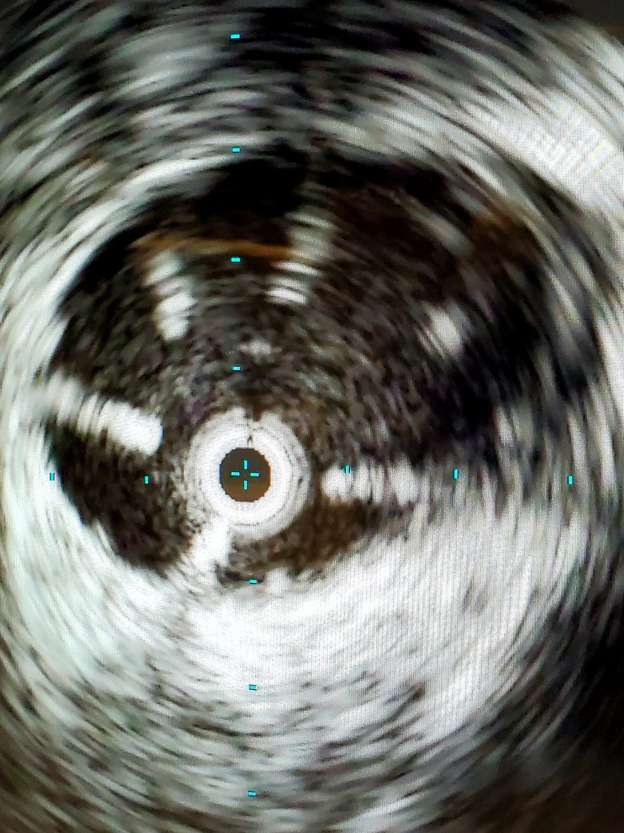 keithppereira's tweet photo. Stepping up the #IRad game...
If the patient cannot come to us, we come to the ICU..
@SLU_VIR Interventional specialists placing a bedside IVC filter #IVCF using Intravascular Ultrasound (IVUS) guidance without fluoroscopy. https://t.co/CN9cT8efHn