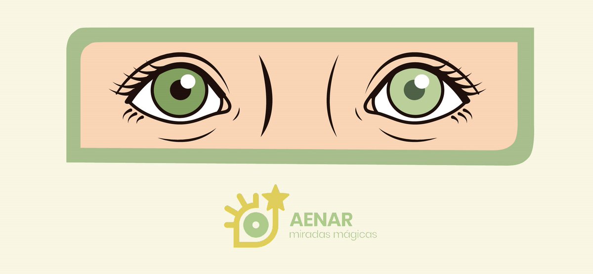 Hoy os hablaremos de la #HeterocromíaDeIris , una anomalía que se produce en los ojos de algunos pacientes con #Retinoblastoma que causa que los ojos sean de diferente color.
