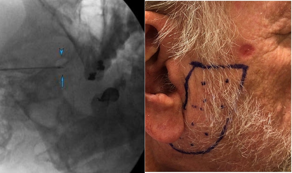 Anesthesia&Analgesia tweet media