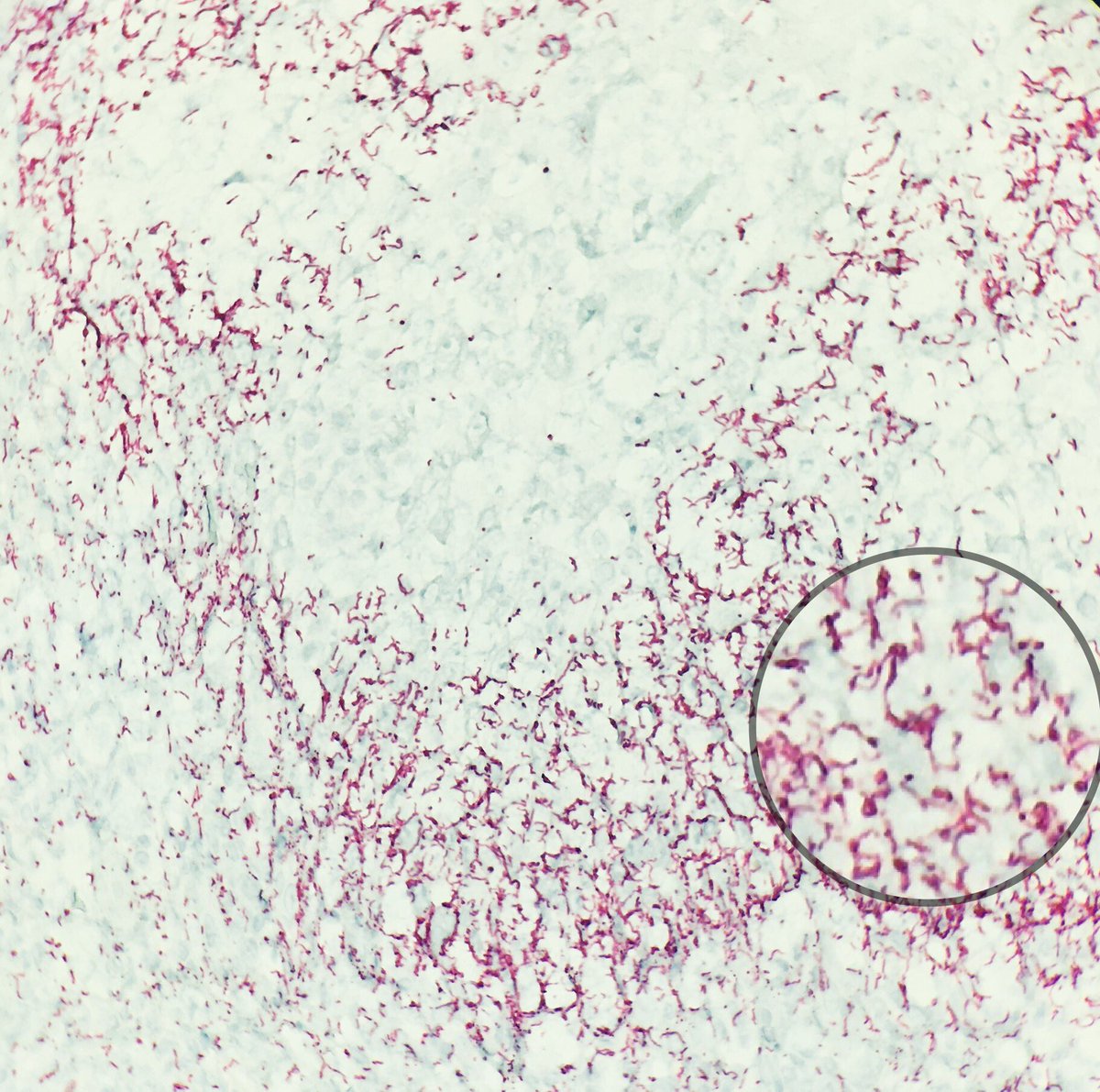 #CondylomataLata #syphilis Marked epidermal hyperplasia, superficial and deep mixed infiltrate with abundant plasma cells obscuring the DEJ. The sensitivity of IHC is of 71%, so the stain doesn’t catch all cases 👀 #dermpath #dermatology