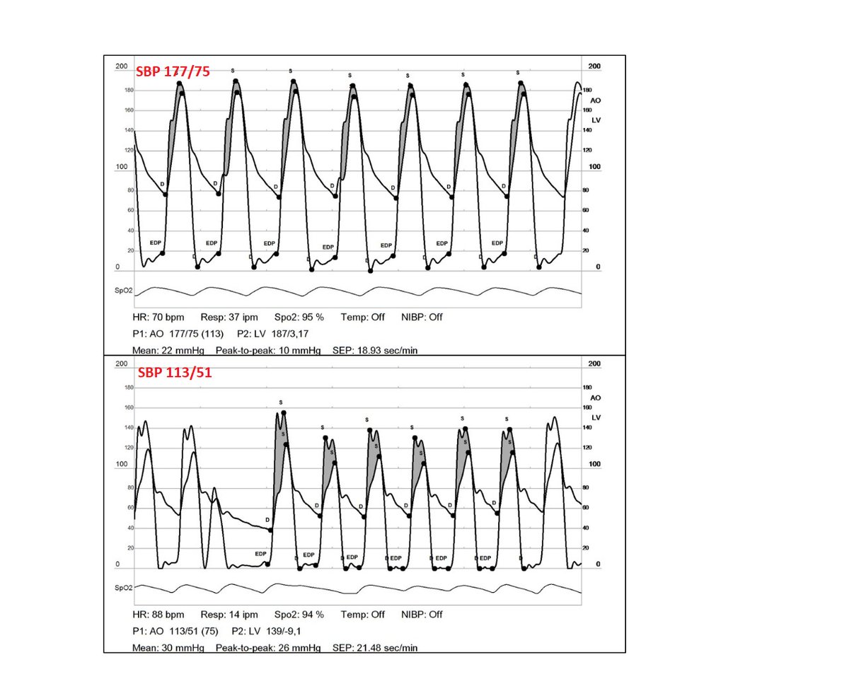 Classic trick: hemodynamic tracing of severe AS before and after nitro. Dropping blood pressure from 180 to 110 unmasks severe AS that could have been missed otherwise due to high impedance and low flow. @PCRonline @rajivxgulati @ChetRihal @AmitSegev8 @Issi_barbash #tavr #vhd