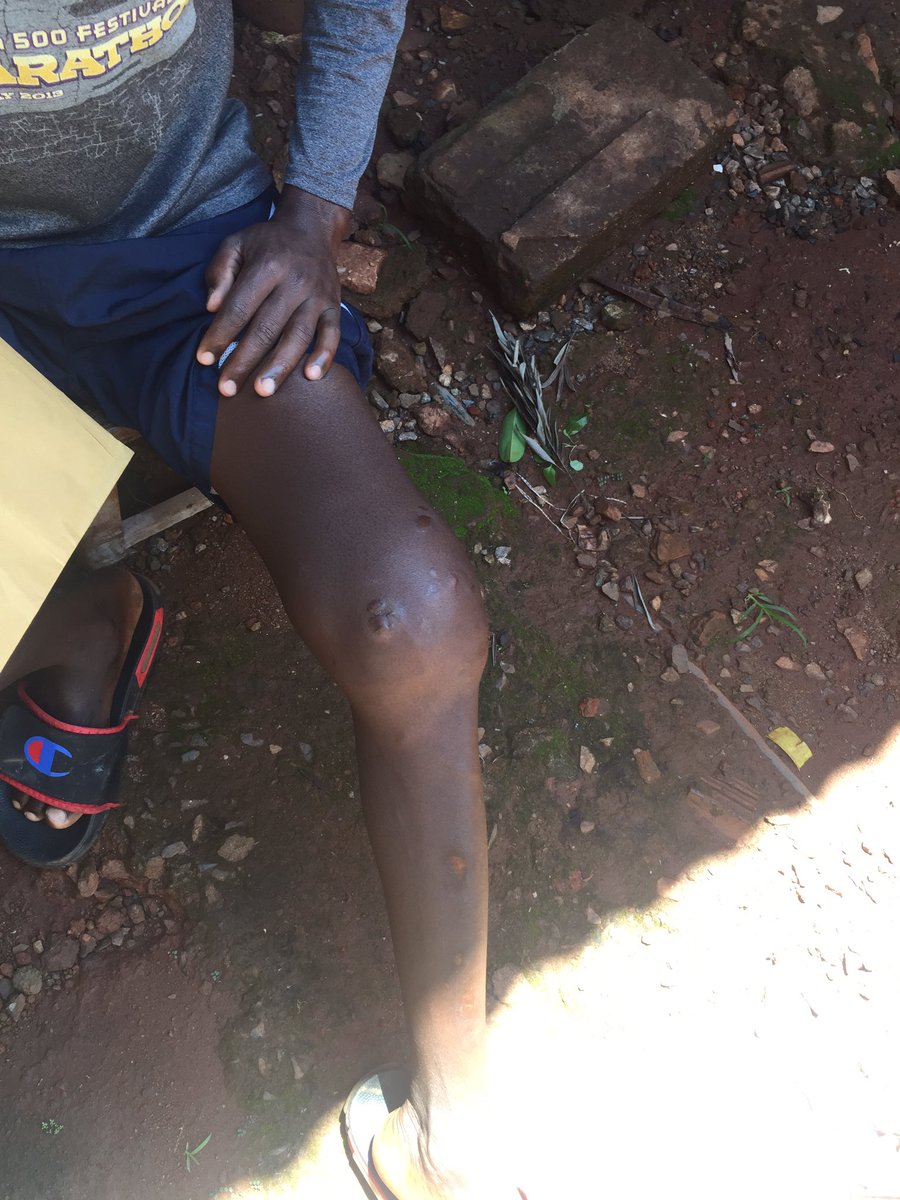 kiWycliffK's tweet photo. Good evening #UOT one of us @samuel_mbatya needs our help of raising UGX 3.4M for the scanning and surgery of his knee. Here is the number of the  donations 0776 628 657( Mbatya Samuel) , all contributions are highly appreciated.

#SaveSamuelMbatya https://t.co/iEt4TVnqey