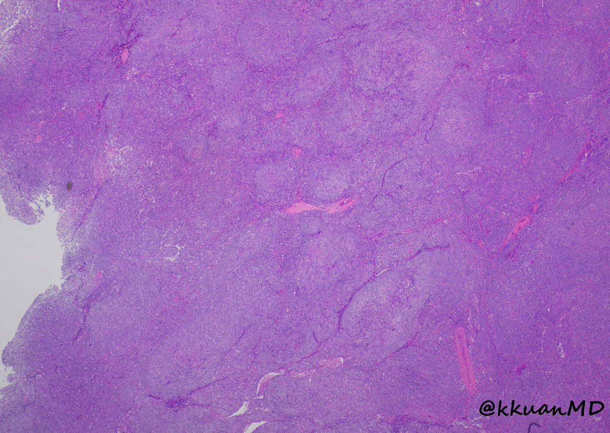 kkuanMD's tweet photo. Angioimmunoblastic T-cell lymphoma: 50yr M with fatigue, weight loss, and generalized lymphadenopathy. Excional biopsy from axillary lymph node: #PathTwitter #hemepath #pathboards #lymphoma @EinsteinPath @c_castrodad @DrVish @anjuthevirgo @c_castrodad @ALBoothMD @SibaElHussein https://t.co/UnQxpTqsJC
