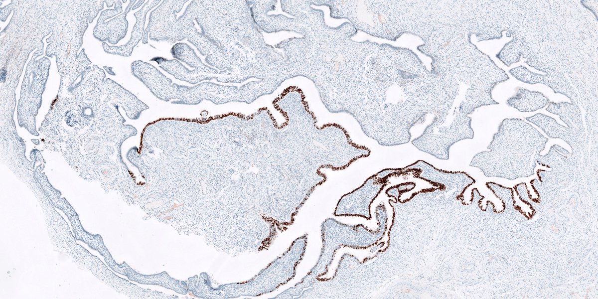 kis_lorand's tweet photo. #PathQuizz What is the stain? What is the diagnosis? 🤔
#pathology #IHCpath https://t.co/XFwXA37e45