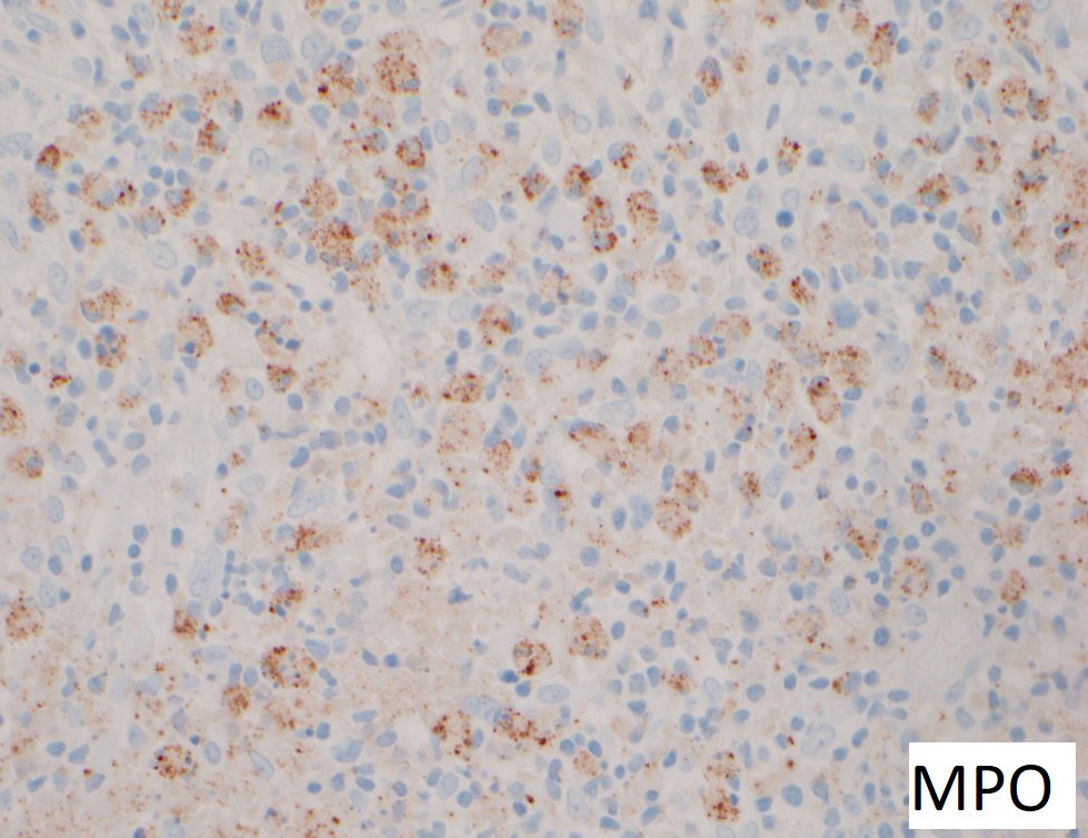 NicholasWardMD's tweet photo. Best case of Kikuchi-Fujimoto I have seen! All three phases: proliferative, necrotizing and xanthomatous. Negative auto-immune panel (no SLE). Why are histiocytes MPO(+)in KFD? 
Plasticity? Functional versatility? Unique/myeloid dendritic cell? https://t.co/lFwJtjEVi6