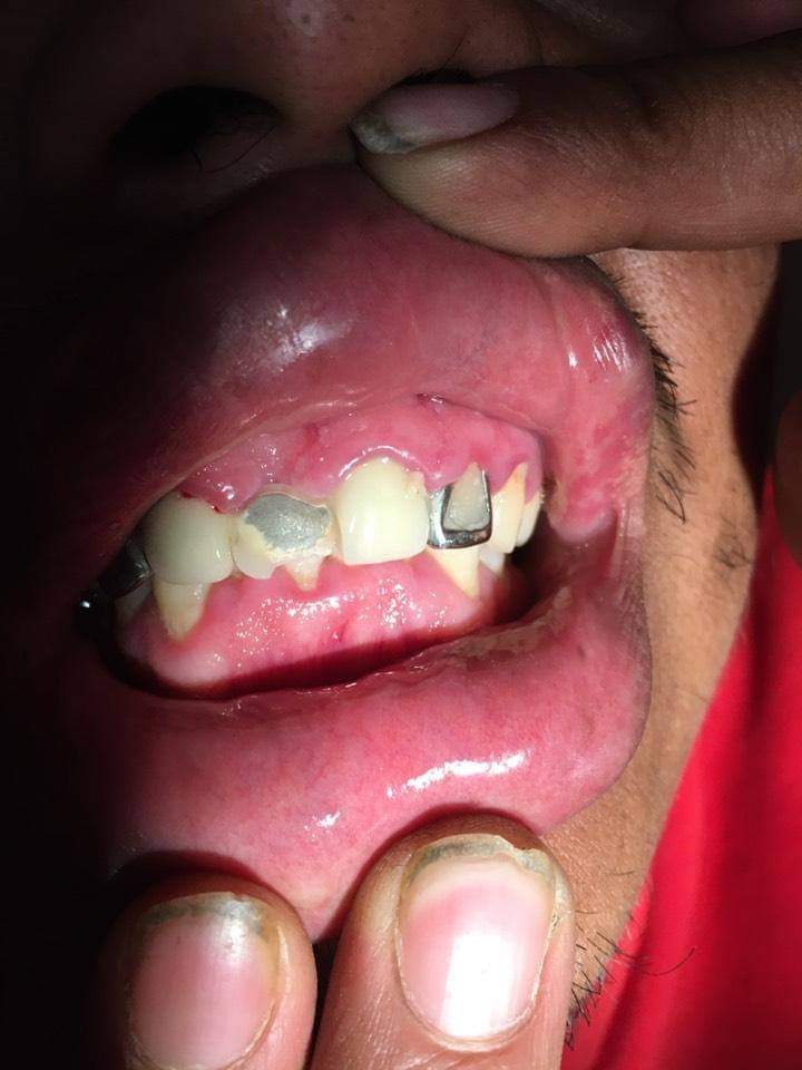 FranDentPerfect's tweet photo. Doctor;
¿Cuánto cuesta una tapadura?
Depende en dónde se atienda, si usted busca precio, no se queje... (las manos son del propio paciente).
Si lo que buscas es calidad, entonces, paga por ello...
#DentalPerfect 
#DéjanosFascinarte 
https://t.co/UJGE0Bup5w 
#OdontologíaDeCalidad https://t.co/zUI1Zgw2Cu