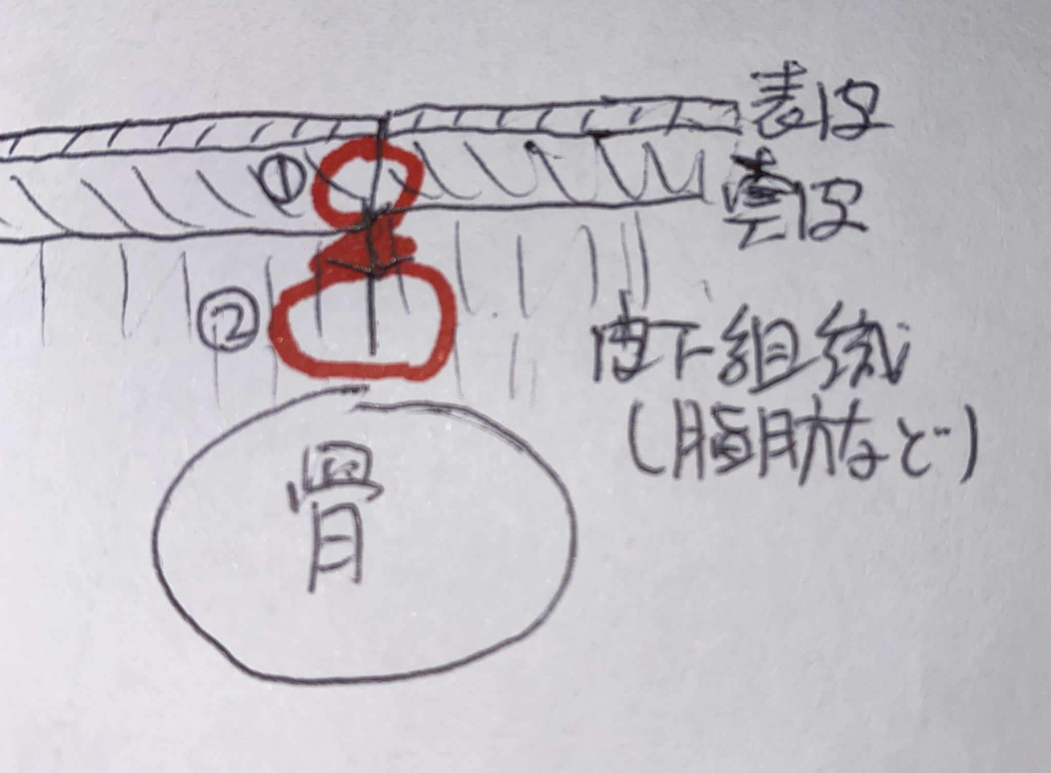 どん Kei180 Rps こんにちは 手術が無事に終わり 経過も良好そうで何よりですね 傷 真皮縫合という縫い方でしょう 皮下組織を縫った の糸 後 のように真皮だけを縫うので皮膚表面には縫合糸は出ません 埋没縫合と言います 皮膚には