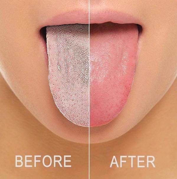 Wondering why you constantly have bad breath yet you brush your teeth???

- Try cleaning your tongue

Tongue cleaning removes the bad breath-generating coating of bacteria, fungi, decaying food particles and dead cells from the surface of the tongue
