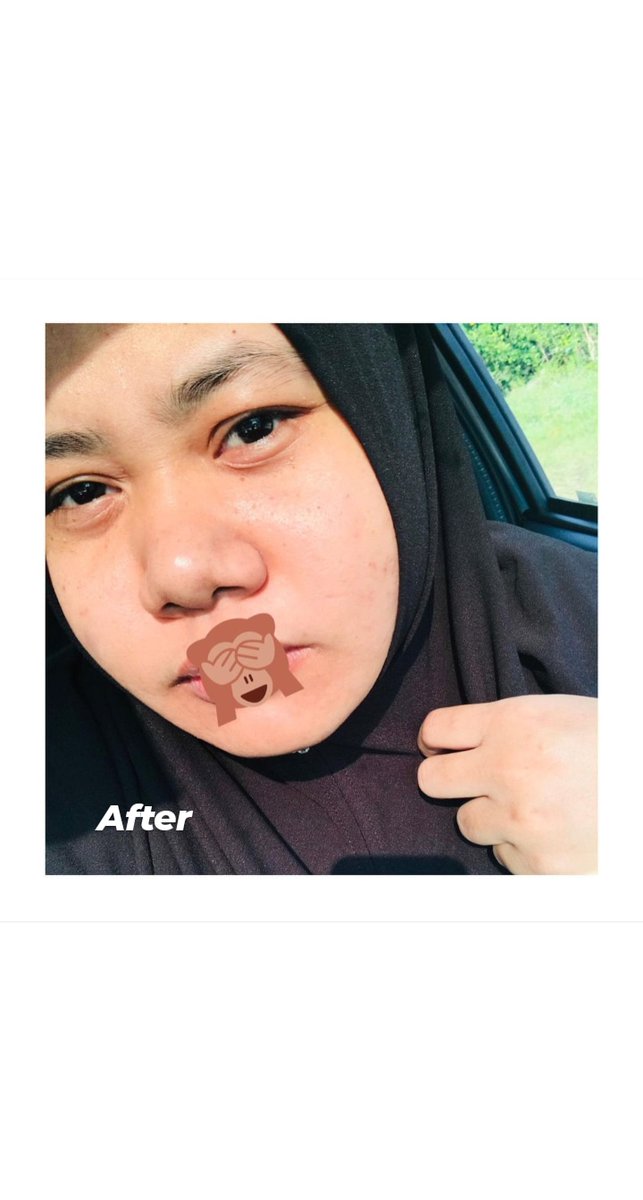 hsnayusoff's tweet photo. I nak share feedback guna skincare from @kaymanbeauty  

Before:                       after: https://t.co/9V3q6JhygB
