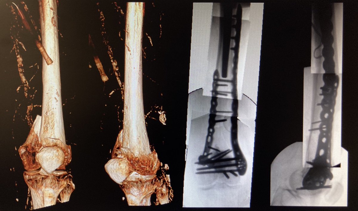 Interesting discussions recently in both clinical practice and emerging literature on these challenging fractures. Learning point for me: &gt;40% intercondylar fractures have a Hoffa fragment. <a href="/BoneJoint360/">Bone & Joint 360</a> October 2020 edition ncbi.nlm.nih.gov/pmc/articles/P… #trauma #orthotwitter