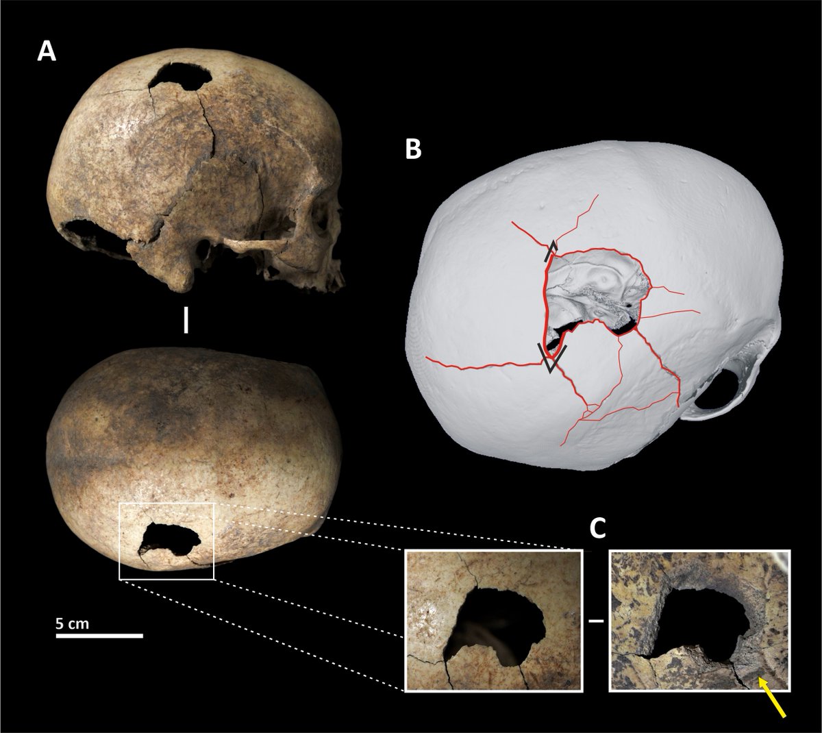 The  #fracture is in the right  #parietal, and we can see a series of radial and concentric  #fissures, with a considerable opening of some of them, and an internal beveling. The V-shaped ends (B) represent the  #PointOfImpact, with two fissures emerging from each of them.