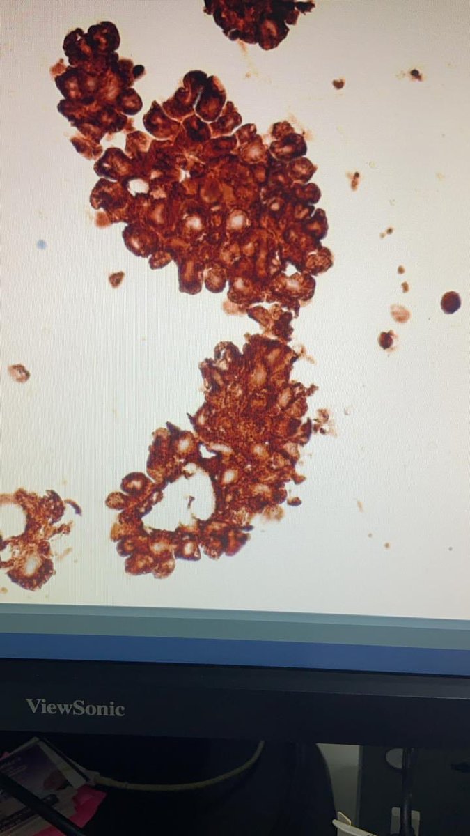 elattar_hicham's tweet photo. Pleural effusion of TTF1 adénocarcinoma /Alk expression on cytoblock ( ventana D5F3) #pathology #pathaward https://t.co/Beu3IHU3hU