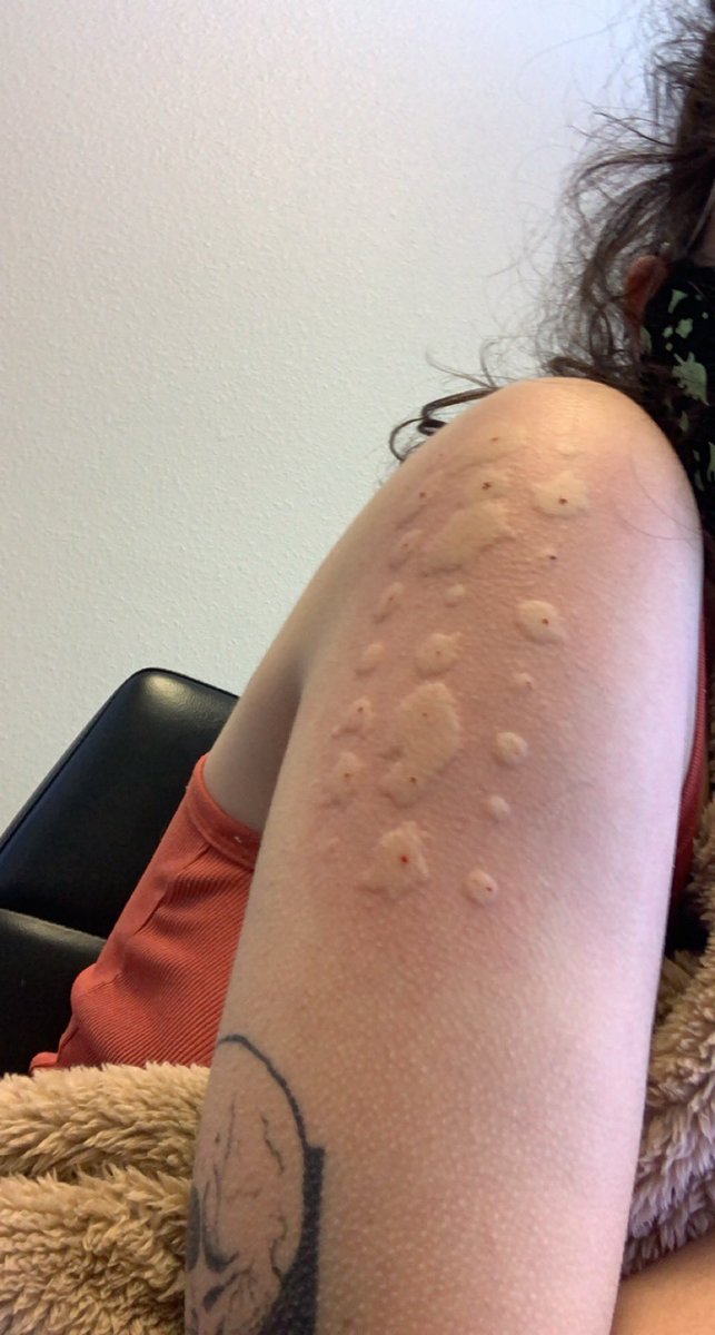 allergy testing went great turns out im allergic to "all of the above"