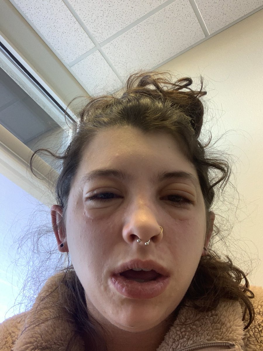 allergy testing went great turns out im allergic to "all of the above"