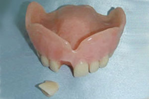 We have an on site lab that has seen it all. Repairs are done as quick as possible as we want you to be back to your smiling self. Most repairs are done within 2-3 hours depending on the complexity. Contact us today!