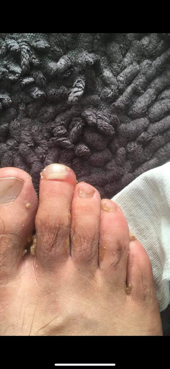 runforreggie's tweet photo. This is what an #Ultra #Runners feet look like after a run

#Sick

All this is for a good cause, raising funds for 4 charitable causes who support people with Down's syndrome!! 

 #RunforReggie #RunforReggieandfriends #MarathonMan https://t.co/G2zoJvHYoK