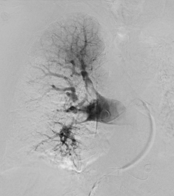 angio_sweet's tweet photo. High risk submassive PE, Bova 5 requiring HFNC (40L, 60% FiO2) ➡️ single session thrombectomy using T20 #FlowTriever. Pt leaves room on 2L NC 👍🏼 Disclaimer: my medical artistic abilities at 1am make clots appear to have been aspirated from the bronchi 🤦🏼♀️ #iRad #noTPA https://t.co/NURxJTourD