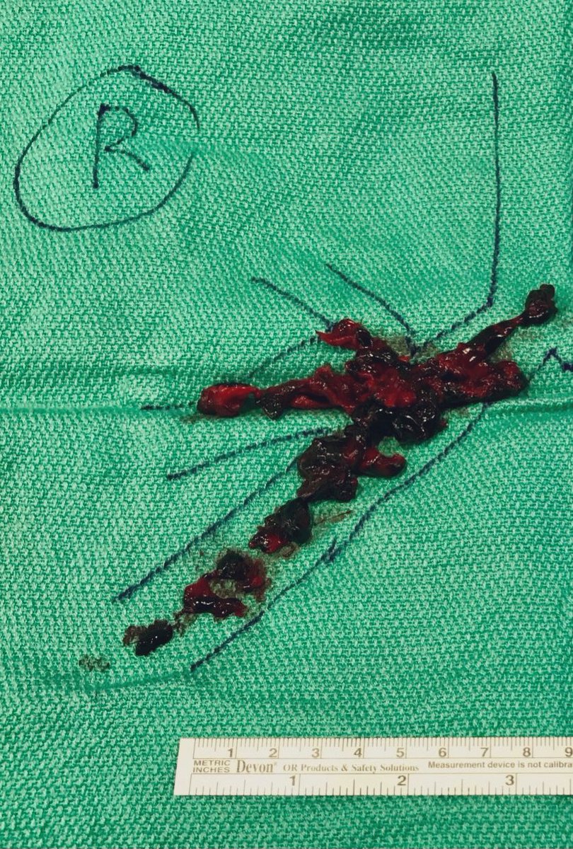 angio_sweet's tweet photo. High risk submassive PE, Bova 5 requiring HFNC (40L, 60% FiO2) ➡️ single session thrombectomy using T20 #FlowTriever. Pt leaves room on 2L NC 👍🏼 Disclaimer: my medical artistic abilities at 1am make clots appear to have been aspirated from the bronchi 🤦🏼♀️ #iRad #noTPA https://t.co/NURxJTourD
