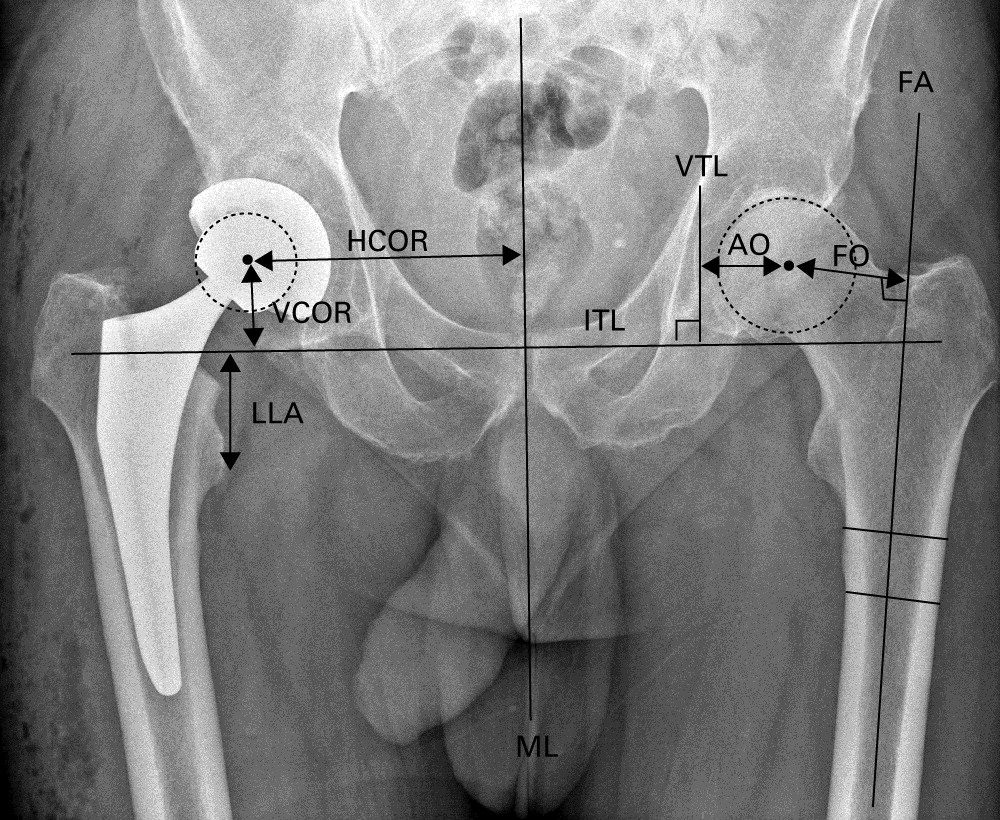 BoneJointJ's tweet photo. Robotic-arm assisted total #hip #arthroplasty (THA) is associated with improved accuracy in restoring the native centre of rotation, better preservation of combined offset &amp; more precise acetabular component positioning compared with manual THA https://t.co/gqHEYWXjZi #openaccess https://t.co/0XaMcEwWrQ