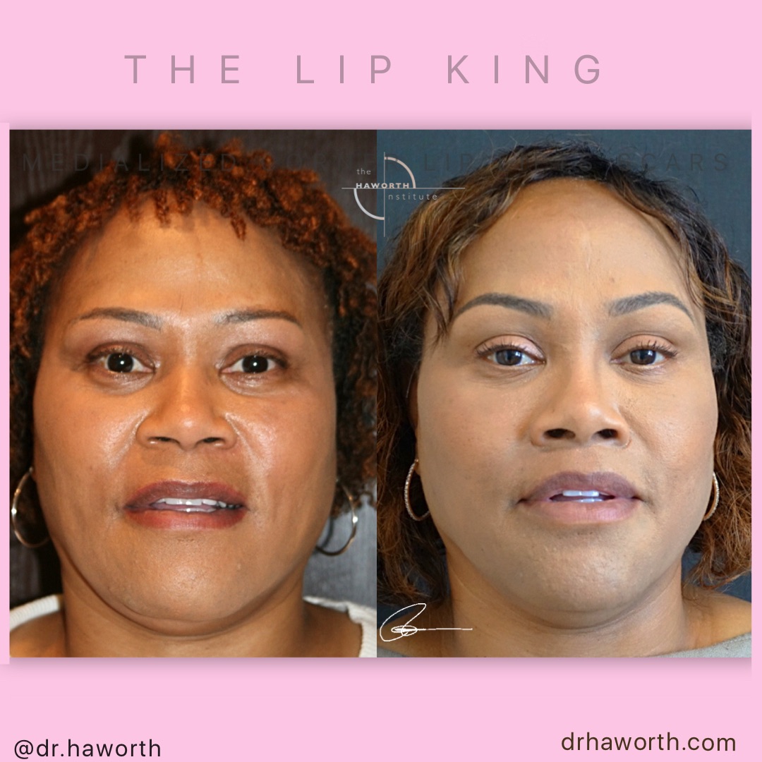 Notice how the face just “pops“ with focus drawn to the eyes even though I just performed my OOS (Orbicularis Oris Suspension) Upper Lip Lift and lower VY plasty. #DrHaworth
.
🌐drhaworth.com