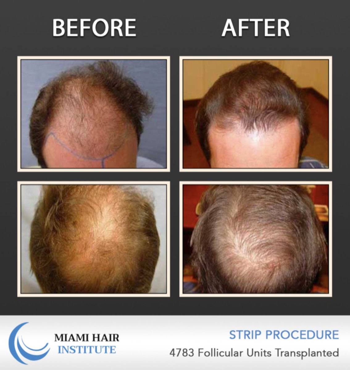 Miami_Hair's tweet photo. #TransformationTuesday at Miami Hair Institute. Check out this natural hairline created by Dr. Nusbaum. 4783 follicular units transplanted with the Strip Donor procedure.
.
.
📞 (305) 925-0222 to schedule a complimentary #HairTransplant evaluation! 
🖥️ https://t.co/AcFs1GVq5I https://t.co/pq9zIbyG8J