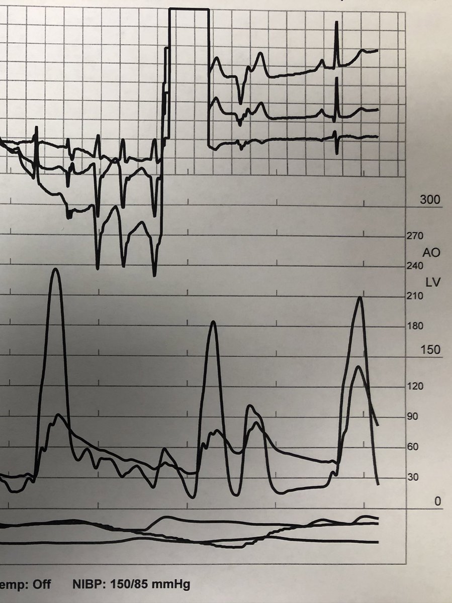 Cath confirms severe outflow obstruction.
