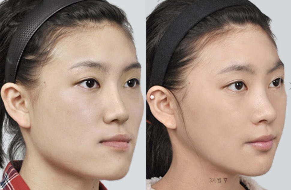 ナビコリア 韓国美容整形 無料サポート 08年から 顎間を固定しないので呼吸が楽に出来る ノータイ両顎手術 ナビコリア がサポート致します 最大泊無料 空港送迎無料 通訳 アフターケア無料 Id美容外科 韓国整形