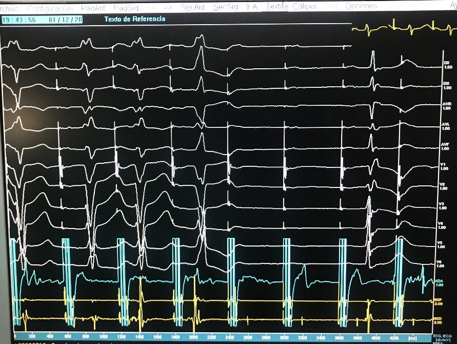 ALFIEEP1's tweet photo. #Epeeps
Food for thought.
89 yof pt. Malignant syncope.
Basal rhythm: SR LBBB
HRA pacing shows this.
Anyone can explain how LBB conducts after this AV block ?
#napkingdrawing
cc @SergioPinski @MarceloHelguera @adribaran @DrGregMichaud
@drpchacko @MDTolgaAksu
@narrowQRS https://t.co/uGwPm4hyNY
