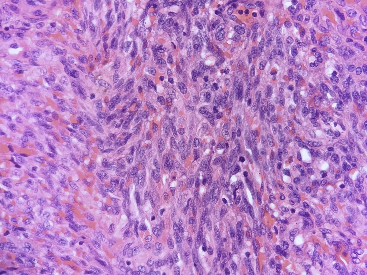 ShirazFidai's tweet photo. 1/2
Kaposi Sarcoma; tumor stage in skin

Young male, AIDS

Guess not enough of these on #PathTwitter 🤓

#surgpath #BSTpath #Medmicro https://t.co/cdAtpMqNII