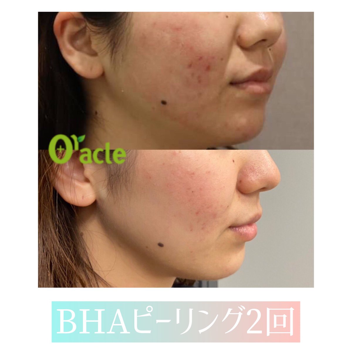 オラクル美容皮膚科 ニキビ治療症例 アグネス ニキビの皮脂腺を直接破壊 Bhaピーリング ニキビ専用サリチル酸ピーリング フラクセル ニキビ跡や凸凹肌改善に ニキビ ニキビ跡 オラクル美容皮膚科