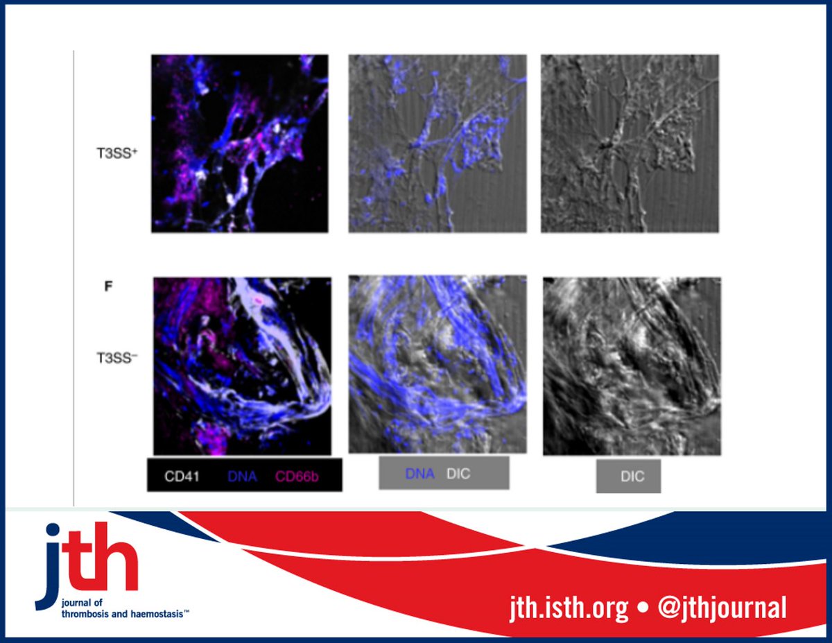 JTH (@jthjournal) on Twitter photo Highlighted #December2020 cover:
#Platelets entrap bacterial pathogens ➡️ immune responses to bacteria. <a href="/samanthapalace/">Sam Palace</a> <a href="/DrKoupenova/">Milka Koupenova</a> show Yersinia pestis 🦠destabilise platelet thrombi, preventing bacterial entrapment in fibrin/platelet clots. bit.ly/33zyIbc Highlighted #December2020 cover:
#Platelets entrap bacterial pathogens ➡️ immune responses to bacteria. <a href="/samanthapalace/">Sam Palace</a> <a href="/DrKoupenova/">Milka Koupenova</a> show Yersinia pestis 🦠destabilise platelet thrombi, preventing bacterial entrapment in fibrin/platelet clots. bit.ly/33zyIbc