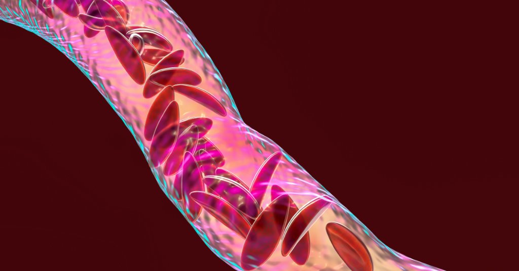 Sickle cell disease makes red blood cells stiff and crescent-shaped, which means blood can’t flow easily through the blood vessels, causing flare-ups of severe pain and leading to anemia, stroke, organ damage, and heart or liver failure. https://t.co/Sdi52bqpxC https://t.co/aVbH60qyEG
