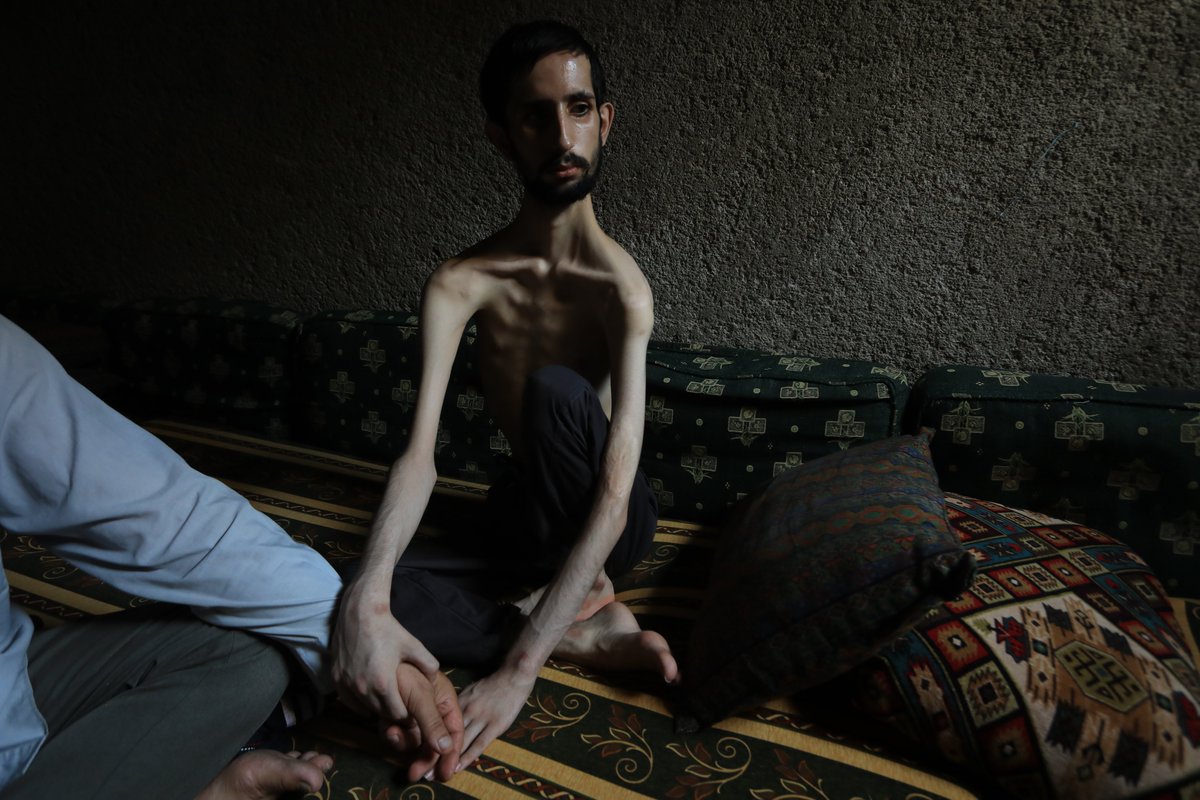Hacikizi's tweet photo. Humuslu Abdullah 18 yaşında ve sadece 35 kilo... Esed rejimi ve destekçilerinin Humus'ta düzenlediği saldırıda başına şarapnel parçasının isabet etmesiyle felç geçirmiş. Babasının bakımıyla hayata tutunan Abdullah, tedavisi için yardım bekliyor. 
📸 @BakrAlkasem @anadoluajansi https://t.co/TvBaCDjyXG