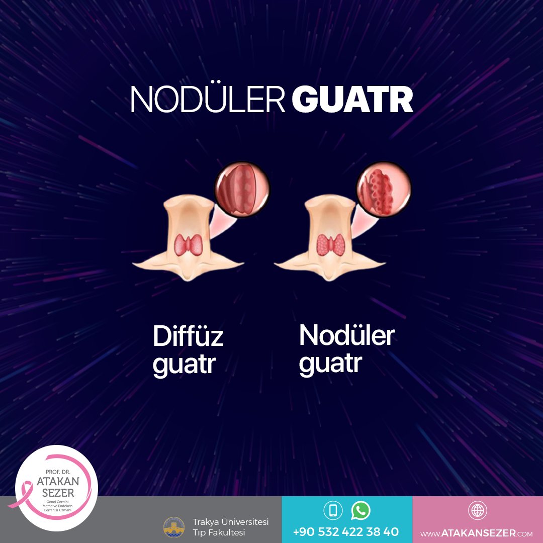 Tiroid hücrelerinin aşırı çoğalması sonucu tiroid bezinde oluşan kitlelere veya içi sıvı dolu kesiciklerden (kistik) oluşan kitlelere tiroid nodülü adı verilir.

atakansezer.com/tedavi/noduler…

#profdratakansezer #genelcerrah #endokrincerrahisi #tiroid 
#tiroidkanseri 
#istanbul #edirne