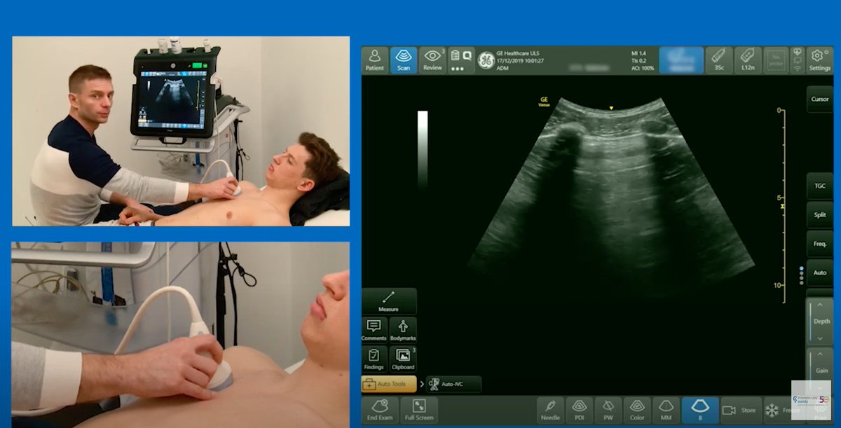 Want to know how to perform lung ultrasound? @GEHealthcare @ICS_updates @I_C_N have collaborated to bring you this video. For more great content visit pocushub.net To find out how to accredit in #FUSIC lung visit bit.ly/3mznP0z ⭐️bit.ly/2JwRjhk⭐️