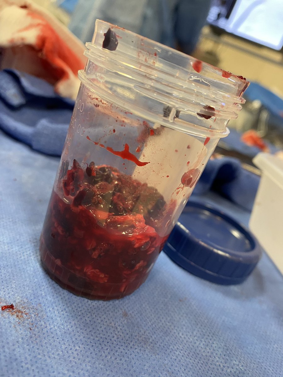 COVID clots are a thing 🩸 #irad