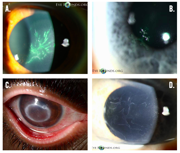 Can you match the findings to the conditions? 1) #HSV, 2) #VZV, 3) #EBMD, 4) #Acanthamoeba?

Thank you to <a href="/uiowaeye/">UIowa Eye</a> <a href="/EyeRounds/">EyeRounds</a> for the fantastic images! 

Answers 👉 lensophthalmology.com/question-of-th…