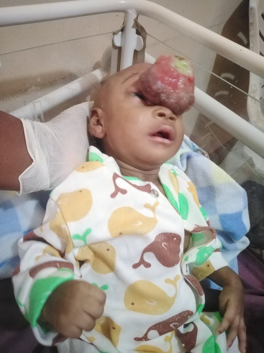 _Hacksam's tweet image. On Monday night I got a call from my friend @ethothikambell about a lady who gave birth to a baby boy with a medical condition that needs urgent attention.

At about 3pm yesterday, I headed to The University of Calabar Teaching Hospital to meet the mother and child.