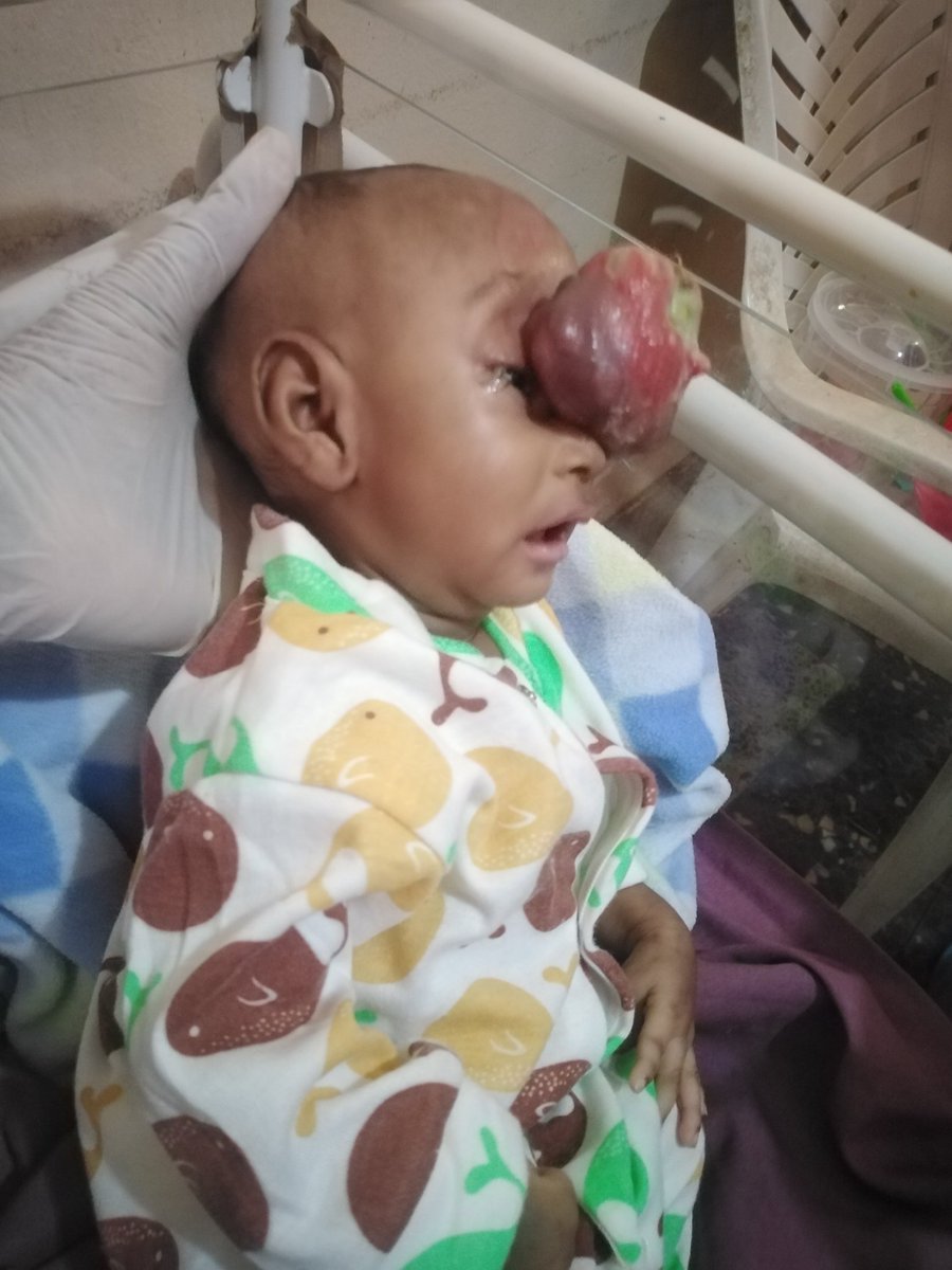 _Hacksam's tweet image. On Monday night I got a call from my friend @ethothikambell about a lady who gave birth to a baby boy with a medical condition that needs urgent attention.

At about 3pm yesterday, I headed to The University of Calabar Teaching Hospital to meet the mother and child.