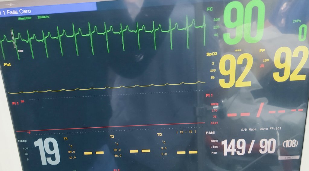 Dr_Dive's tweet photo. Espero reforzar un poco mas el concepto de #Plets y monitoreo. 👩🏻50@, HAS Tx BB, DM Insulina. Impacto💥🚗, no cinturón. Cráneo, tórax, abdomen☑️asimetría🦵🏼. Signos vitales al ingreso⬇️ E-FAST negativo.
¿Algo que sea de su atención? #ConceptosGlobal #FOAMex https://t.co/4St9Euwo1D