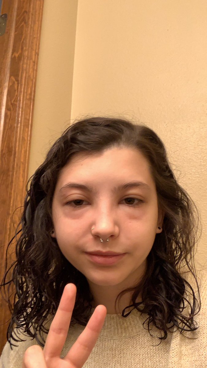 this is 24 hrs after the initial test, I'm still puffy. and guess what today is? that's right! the day I get my picture taken for my new teaching position 