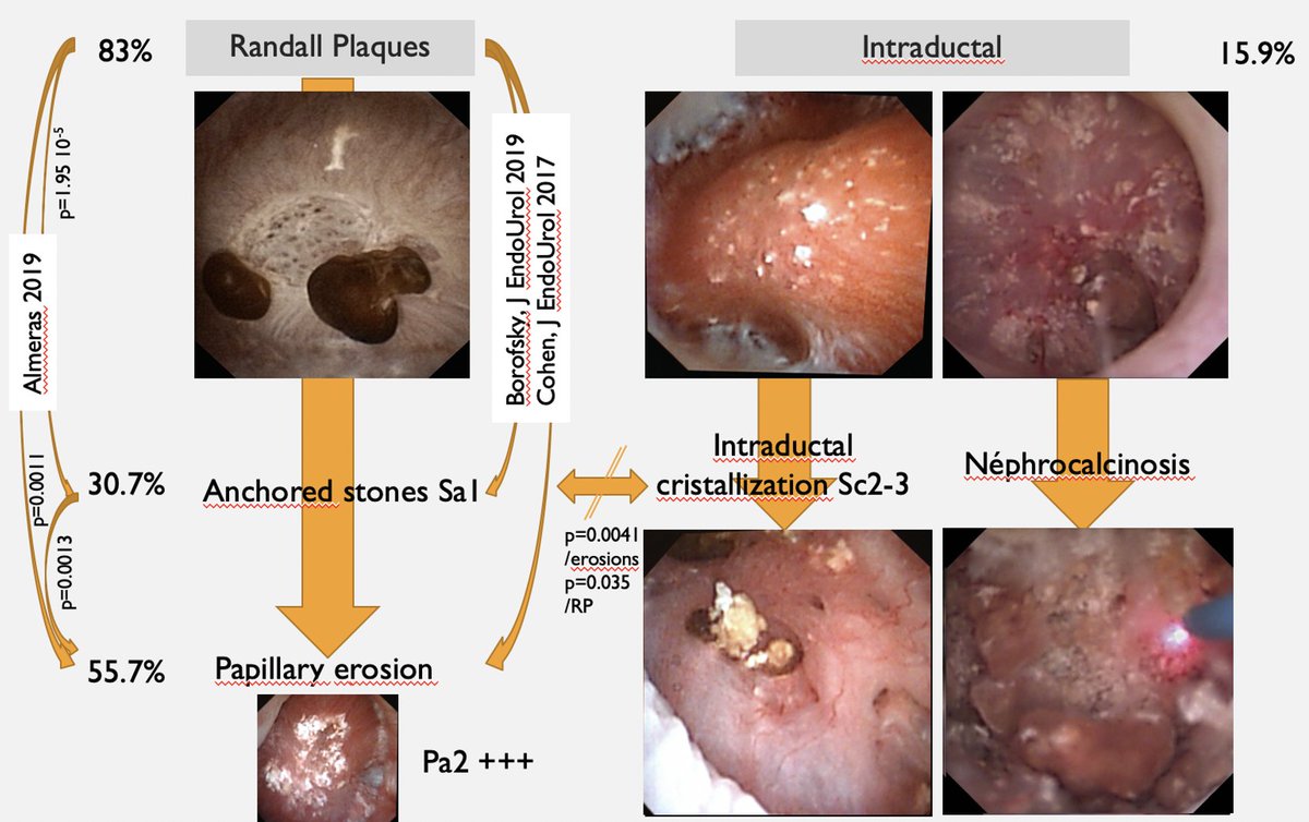 Christophe ALMERAS (@dr_almeras_uro) on Twitter photo one of the aims to describe the papillary abnormalities during flexible #ureteroscopies is to find the type of #crystallization
🌖on #Randall Plaques
🌒by intraductal crystallization
‼️ different #lithogenesis
<a href="/AFUrologie/">Association Française d'Urologie - AFU</a> <a href="/AmerUrological/">Amer. Urol. Assn.</a> <a href="/eulis_uroweb/">European Section of Urolithiasis - EULIS</a>
pubmed.ncbi.nlm.nih.gov/32193654/ one of the aims to describe the papillary abnormalities during flexible #ureteroscopies is to find the type of #crystallization
🌖on #Randall Plaques
🌒by intraductal crystallization
‼️ different #lithogenesis
<a href="/AFUrologie/">Association Française d'Urologie - AFU</a> <a href="/AmerUrological/">Amer. Urol. Assn.</a> <a href="/eulis_uroweb/">European Section of Urolithiasis - EULIS</a>
pubmed.ncbi.nlm.nih.gov/32193654/
