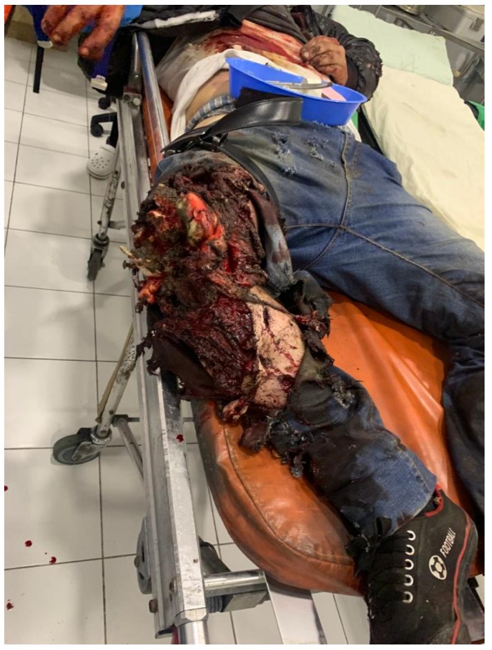 Some evidence on the use of white phosphorus by  #Azerbaijan in Artsakh, endangering not only human lives, but also the flora and fauna, and causing serious environmental issues.  https://www.france24.com/en/europe/20201119-nagorno-karabakh-ceasefire-armenia-accuses-azerbaijan-of-using-phosphorus-bombs  https://artsakhombuds.am/en/document/761&nbsp;