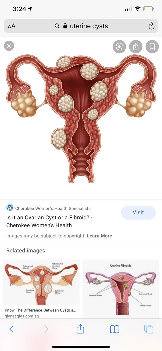 Not only are black women more likely to get them but they’re likely to be LARGER. This is not to scare you but you need to be aware because doctors are NOT going to tell you. Here is a picture for reference and some signs you might be suffering from fibroids/cysts.